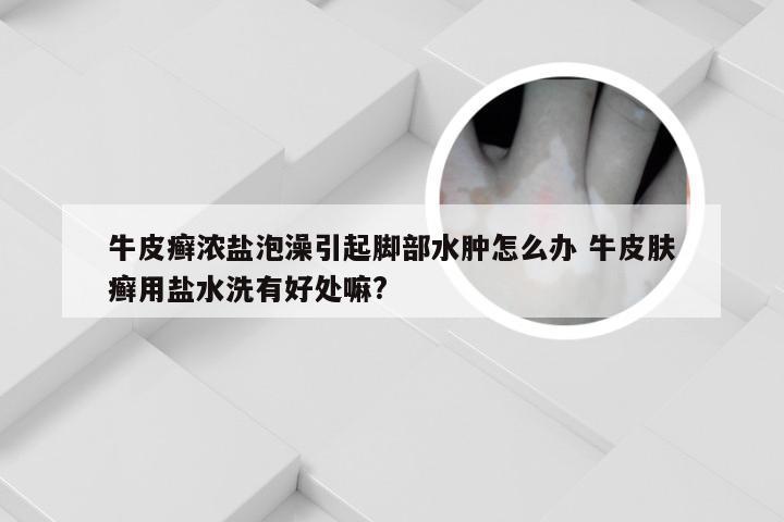 牛皮癣浓盐泡澡引起脚部水肿怎么办 牛皮肤癣用盐水洗有好处嘛?