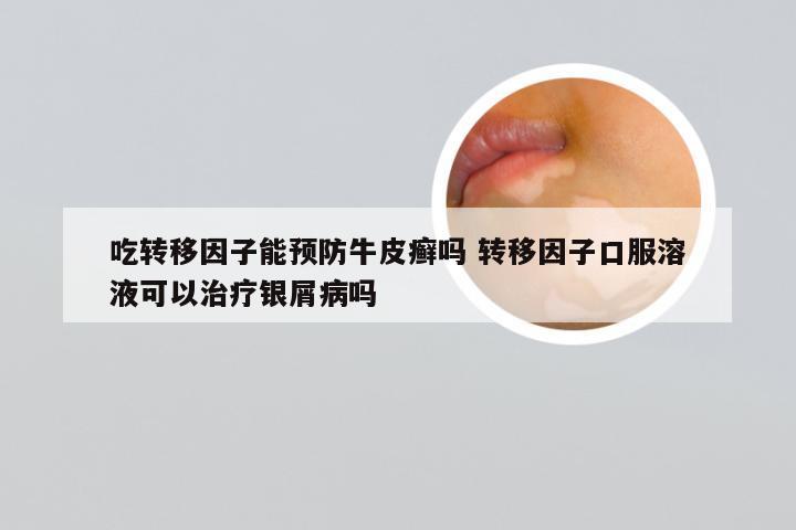 吃转移因子能预防牛皮癣吗 转移因子口服溶液可以治疗银屑病吗