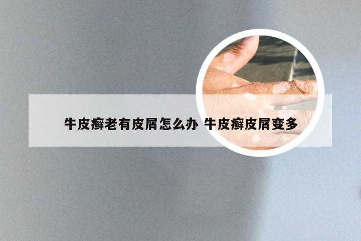 牛皮癣老有皮屑怎么办 牛皮癣皮屑变多