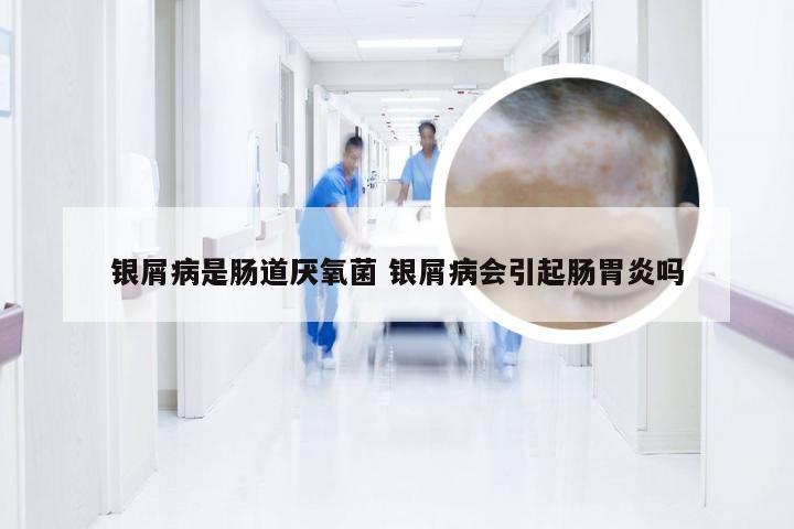 银屑病是肠道厌氧菌 银屑病会引起肠胃炎吗