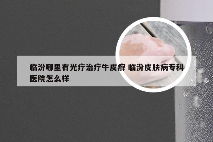 临汾哪里有光疗治疗牛皮癣 临汾皮肤病专科医院怎么样