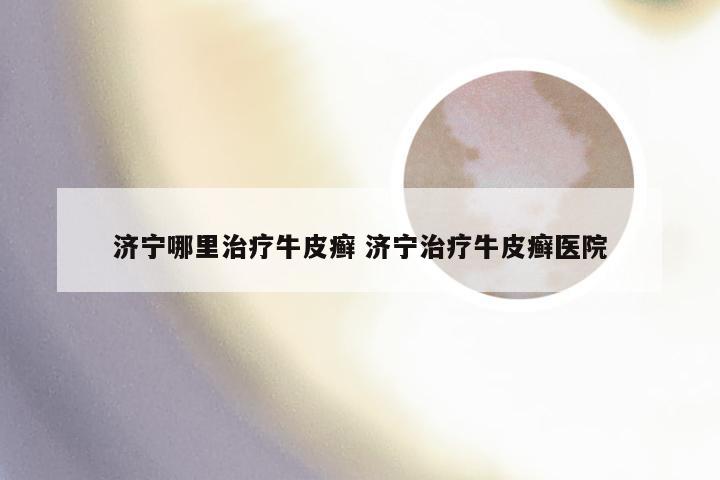 济宁哪里治疗牛皮癣 济宁治疗牛皮癣医院