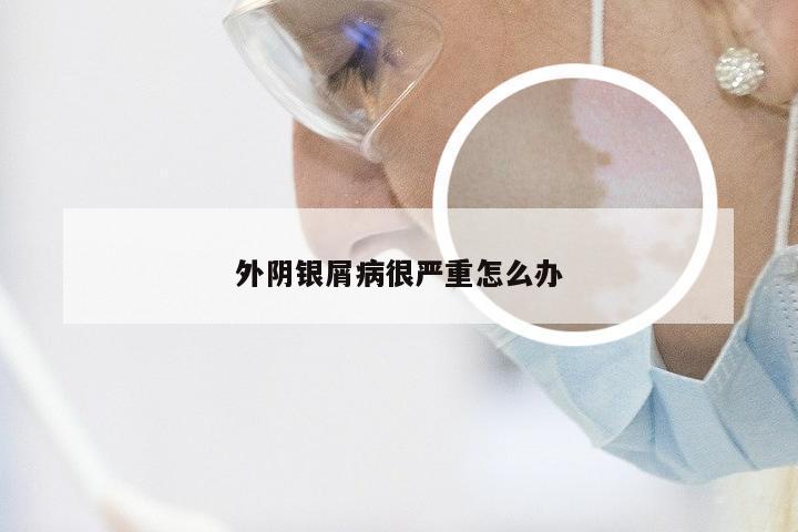 外阴银屑病很严重怎么办