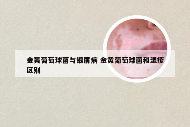 金黄葡萄球菌与银屑病 金黄葡萄球菌和湿疹区别
