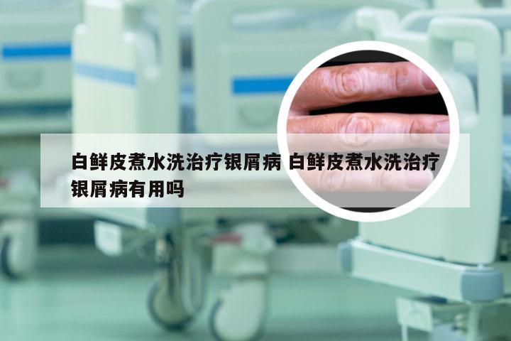 白鲜皮煮水洗治疗银屑病 白鲜皮煮水洗治疗银屑病有用吗