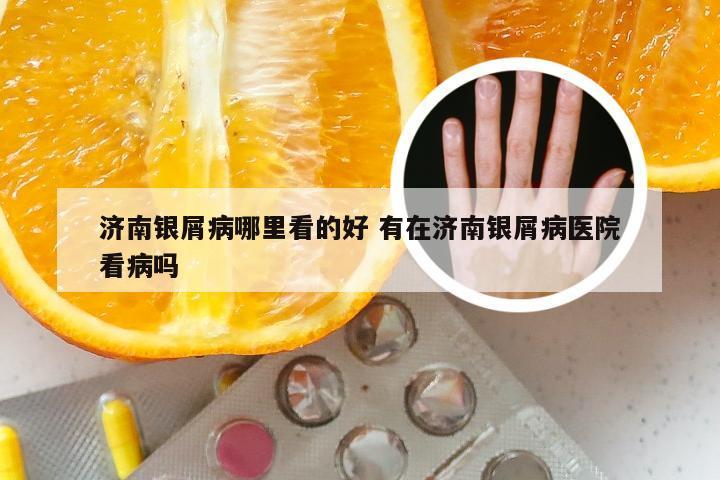 济南银屑病哪里看的好 有在济南银屑病医院看病吗