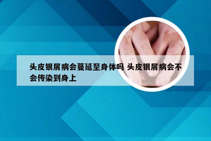 头皮银屑病会蔓延至身体吗 头皮银屑病会不会传染到身上