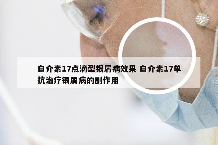 白介素17点滴型银屑病效果 白介素17单抗治疗银屑病的副作用