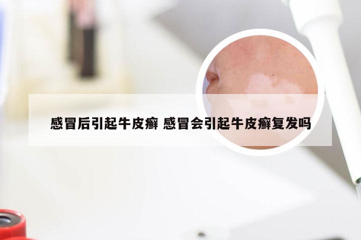 感冒后引起牛皮癣 感冒会引起牛皮癣复发吗