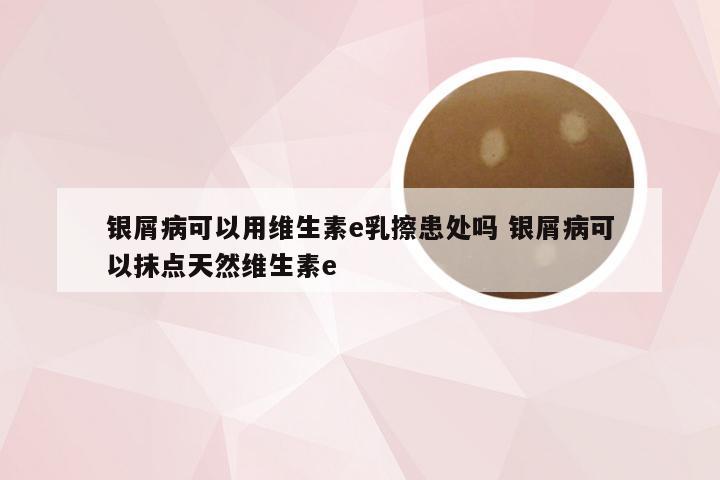 银屑病可以用维生素e乳擦患处吗 银屑病可以抹点天然维生素e