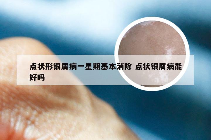 点状形银屑病一星期基本消除 点状银屑病能好吗
