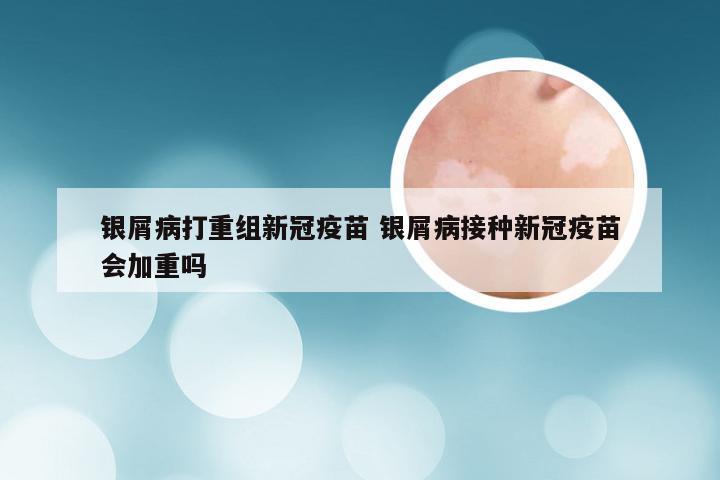 银屑病打重组新冠疫苗 银屑病接种新冠疫苗会加重吗