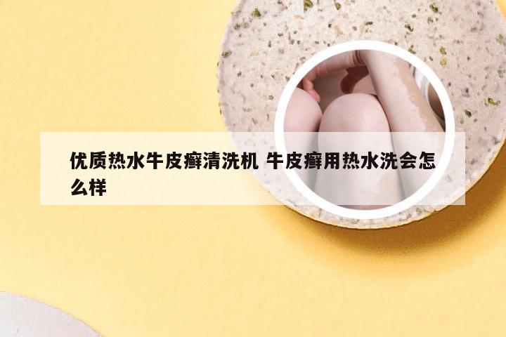 优质热水牛皮癣清洗机 牛皮癣用热水洗会怎么样