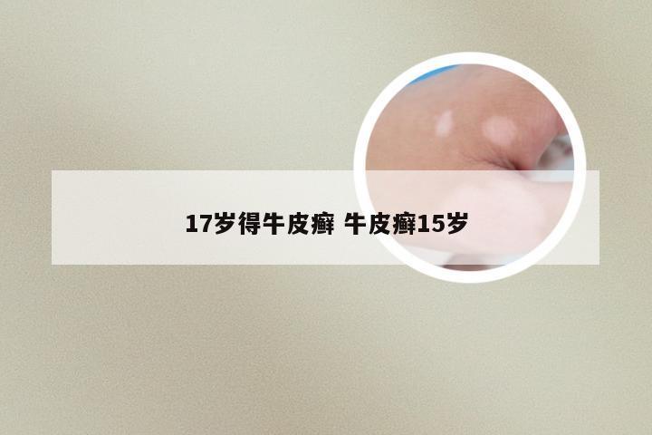 17岁得牛皮癣 牛皮癣15岁