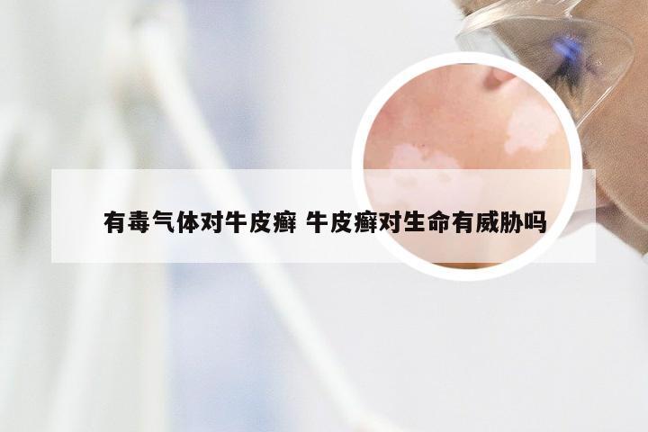 有毒气体对牛皮癣 牛皮癣对生命有威胁吗