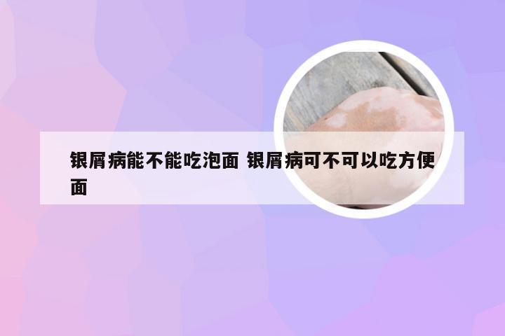 银屑病能不能吃泡面 银屑病可不可以吃方便面