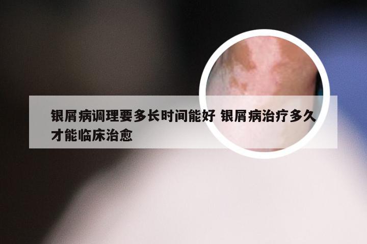 银屑病调理要多长时间能好 银屑病治疗多久才能临床治愈