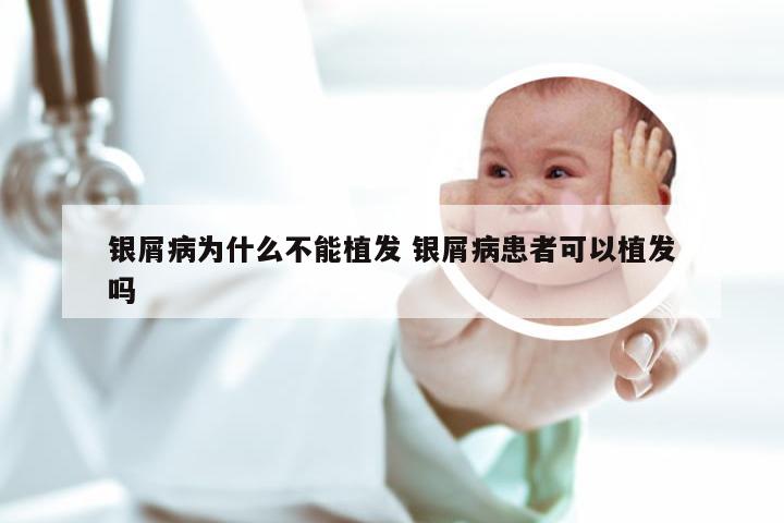 银屑病为什么不能植发 银屑病患者可以植发吗