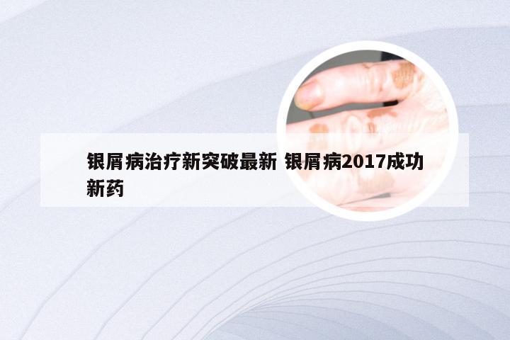 银屑病治疗新突破最新 银屑病2017成功新药