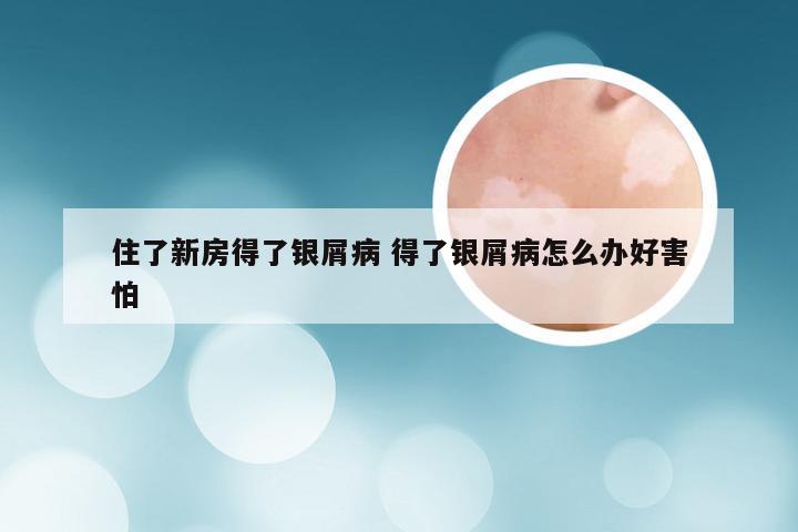 住了新房得了银屑病 得了银屑病怎么办好害怕