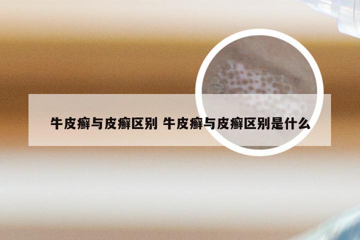 牛皮癣与皮癣区别 牛皮癣与皮癣区别是什么