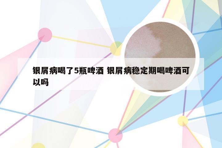 银屑病喝了5瓶啤酒 银屑病稳定期喝啤酒可以吗