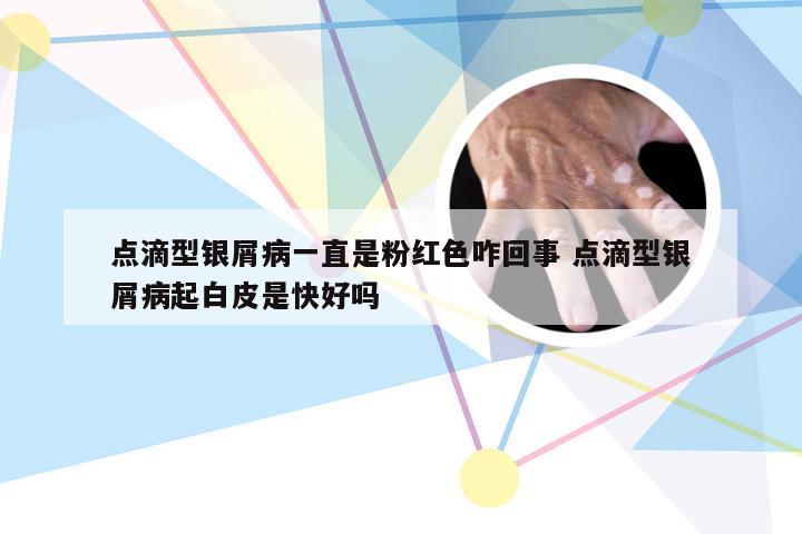 点滴型银屑病一直是粉红色咋回事 点滴型银屑病起白皮是快好吗