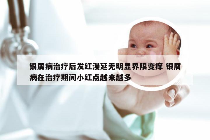 银屑病治疗后发红漫延无明显界限变痒 银屑病在治疗期间小红点越来越多