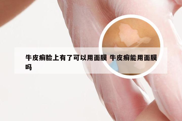 牛皮癣脸上有了可以用面膜 牛皮癣能用面膜吗