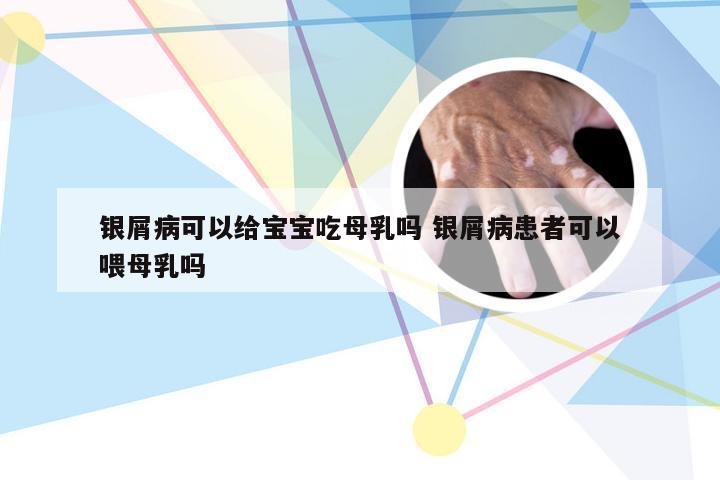 银屑病可以给宝宝吃母乳吗 银屑病患者可以喂母乳吗