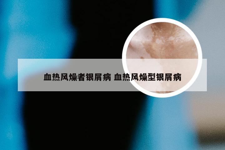 血热风燥者银屑病 血热风燥型银屑病