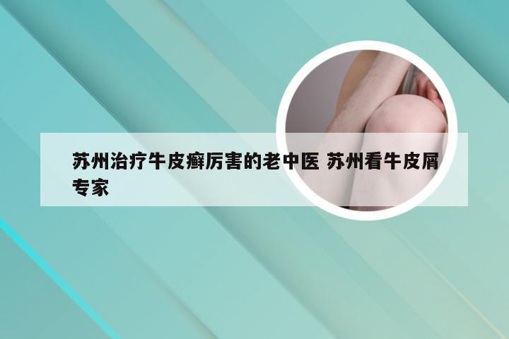 苏州治疗牛皮癣厉害的老中医 苏州看牛皮屑专家