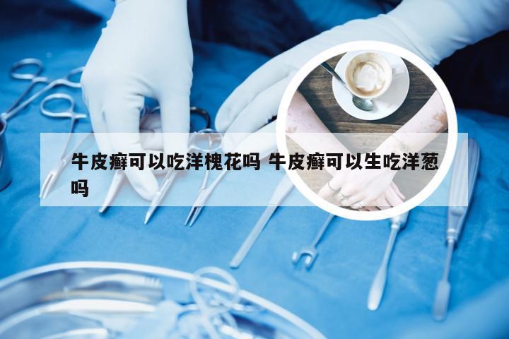 牛皮癣可以吃洋槐花吗 牛皮癣可以生吃洋葱吗
