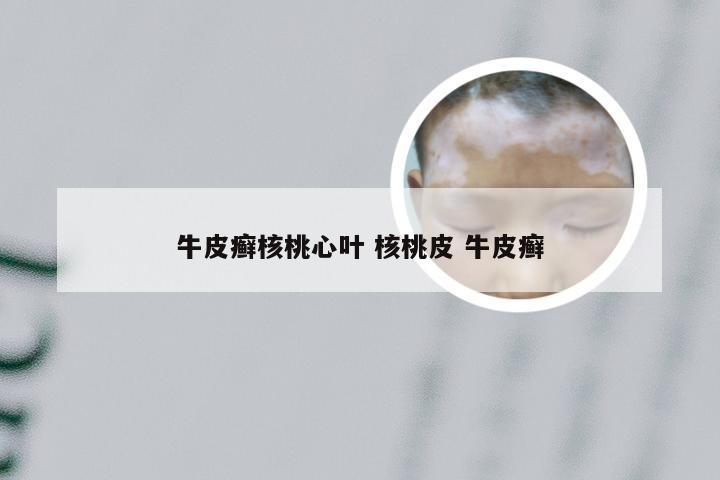 牛皮癣核桃心叶 核桃皮 牛皮癣