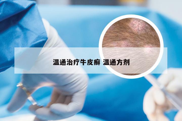 温通治疗牛皮癣 温通方剂