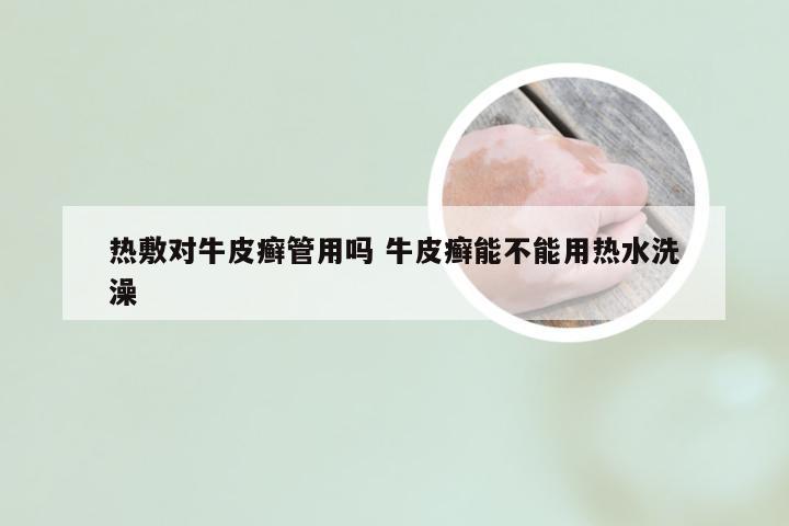 热敷对牛皮癣管用吗 牛皮癣能不能用热水洗澡