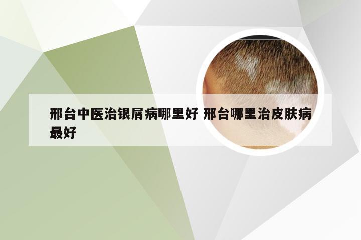 邢台中医治银屑病哪里好 邢台哪里治皮肤病最好