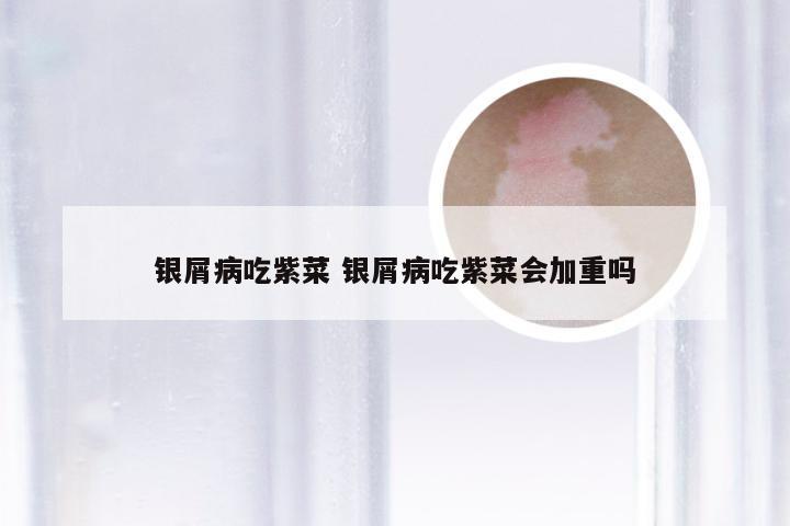 银屑病吃紫菜 银屑病吃紫菜会加重吗