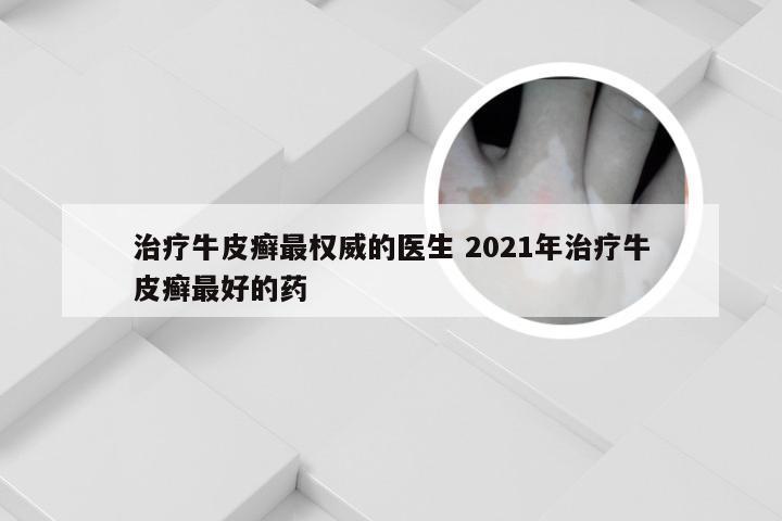 治疗牛皮癣最权威的医生 2021年治疗牛皮癣最好的药