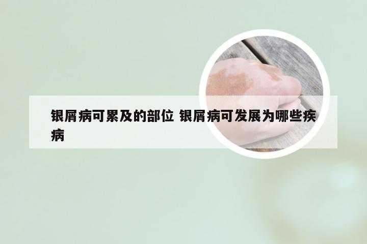 银屑病可累及的部位 银屑病可发展为哪些疾病