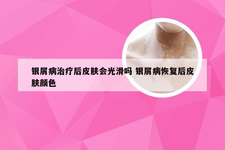 银屑病治疗后皮肤会光滑吗 银屑病恢复后皮肤颜色
