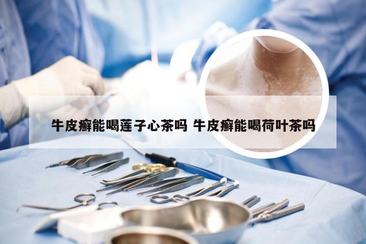 牛皮癣能喝莲子心茶吗 牛皮癣能喝荷叶茶吗