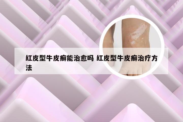 红皮型牛皮癣能治愈吗 红皮型牛皮癣治疗方法