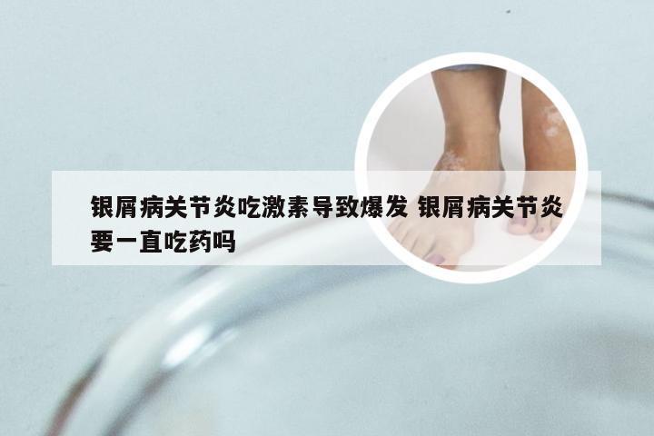 银屑病关节炎吃激素导致爆发 银屑病关节炎要一直吃药吗