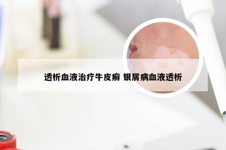 透析血液治疗牛皮癣 银屑病血液透析