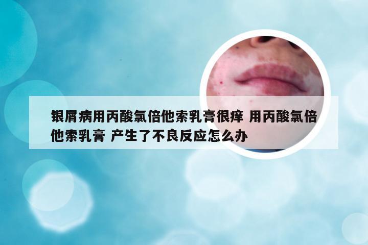 银屑病用丙酸氯倍他索乳膏很痒 用丙酸氯倍他索乳膏 产生了不良反应怎么办