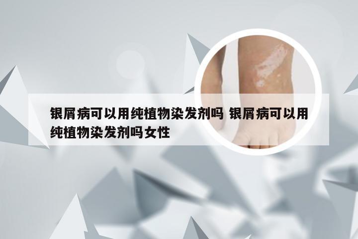 银屑病可以用纯植物染发剂吗 银屑病可以用纯植物染发剂吗女性