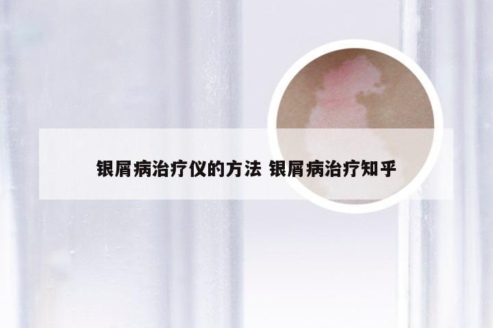 银屑病治疗仪的方法 银屑病治疗知乎