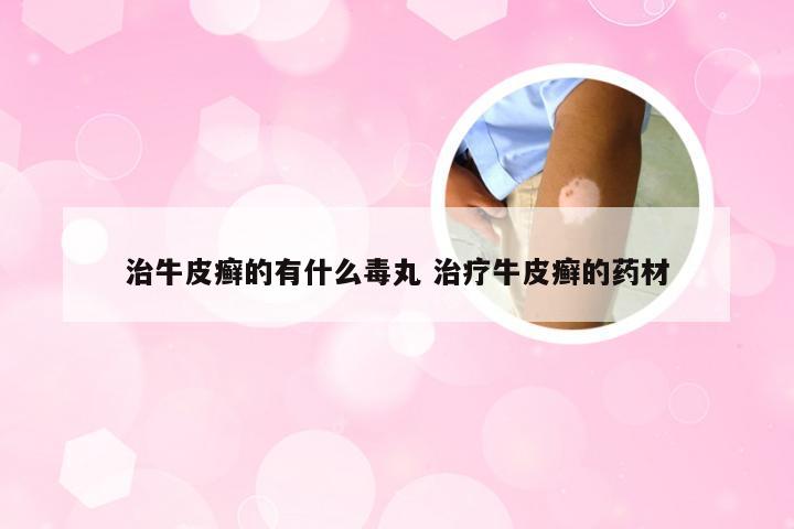 治牛皮癣的有什么毒丸 治疗牛皮癣的药材
