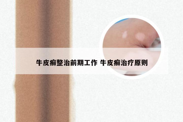 牛皮癣整治前期工作 牛皮癣治疗原则